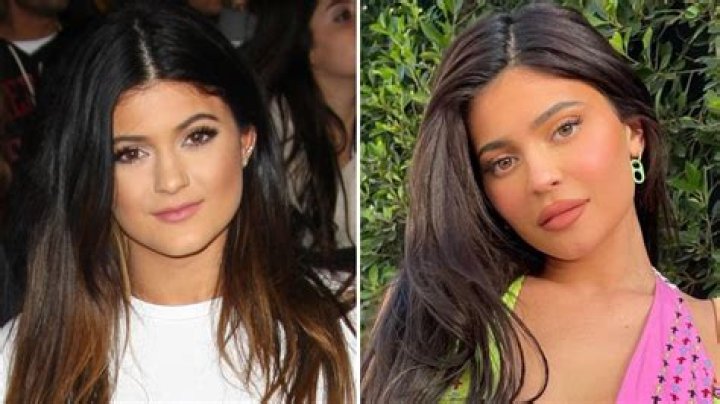 Has Kylie Jenner Had Any Cosmetic Surgeries To Her Face?