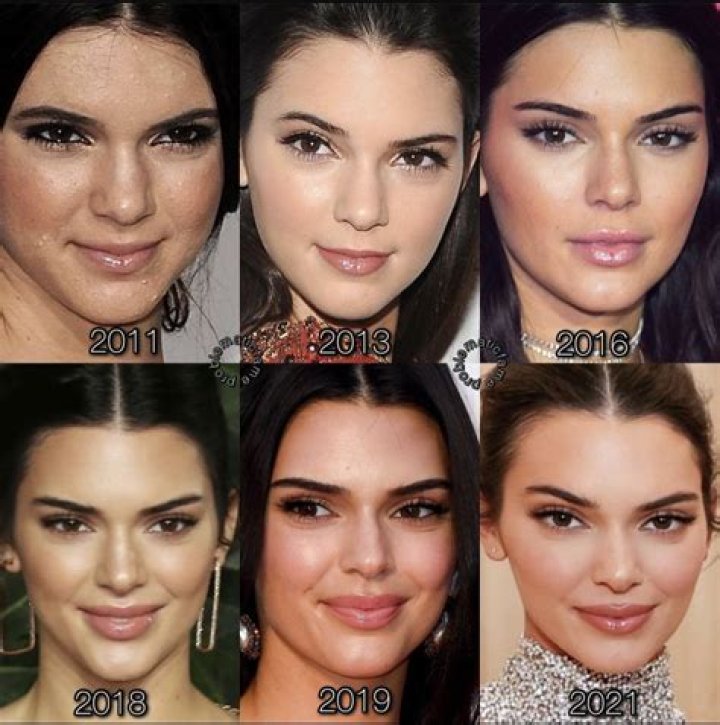 Kendall Jenner&rsquo;s Lip Evolution