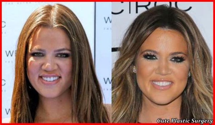 Khloe Kardashian Fillers