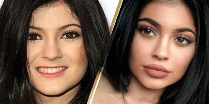 Kylie Jenner&rsquo;s Lips